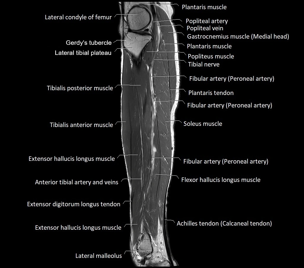 Lower leg sagittal anatomy 3T MRI image 14.webp